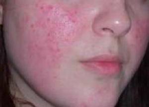 розацеа на лице фото