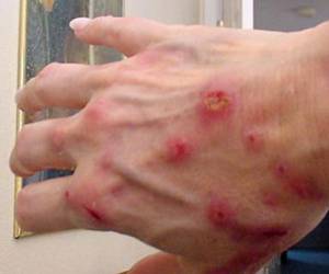 нейродермит фото на руках