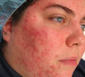 угревая сыпь на лице у взрослого фото