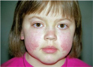 системная красная волчанка фото