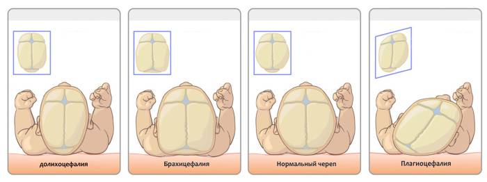 Деформации черепа