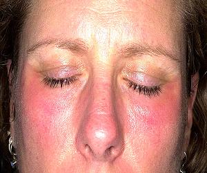 аллергический дерматит на лице фото