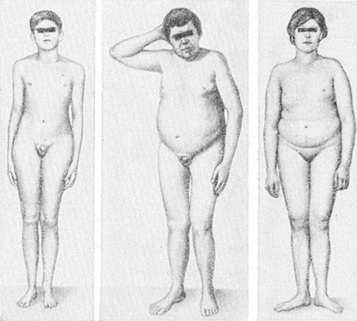 ·евнухоидный вариант телосложения