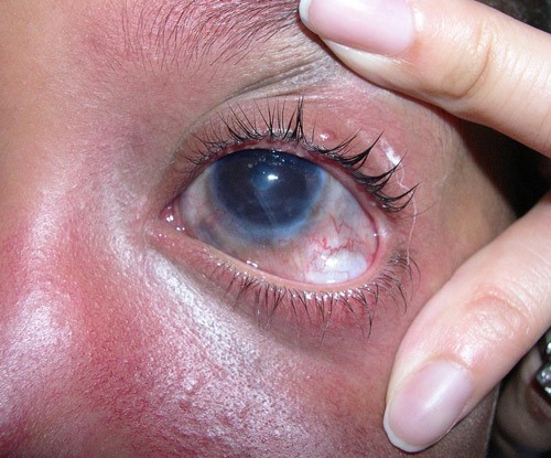 Глазные признаки гемангиомы