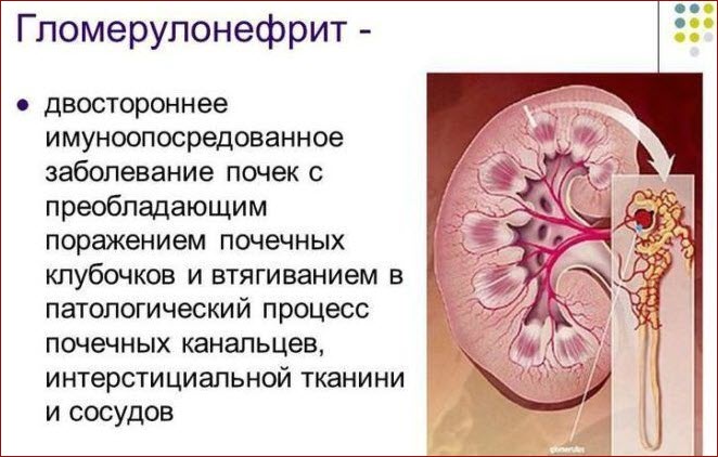 Гломерулонефрит