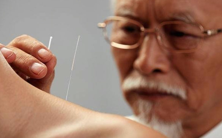 Иглоукалывание