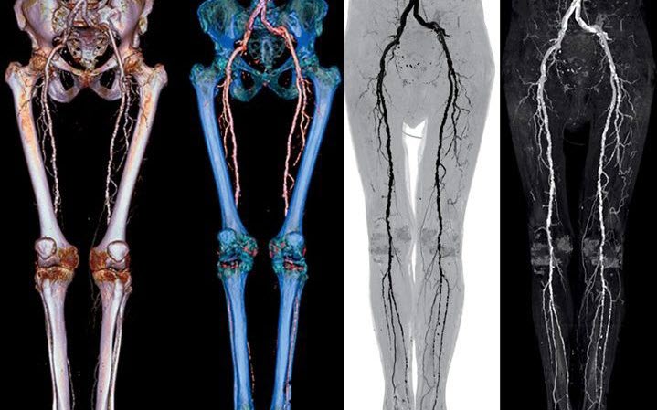 Компьютерная томография вен с применением контраста