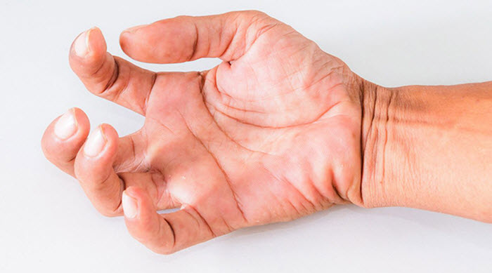 Мышечная дистония у взрослых