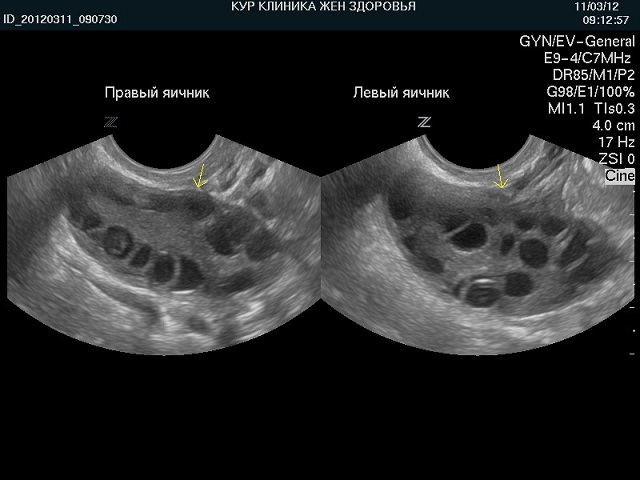 УЗИ яичников