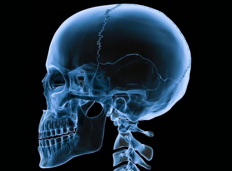 Рентгенография черепной коробки