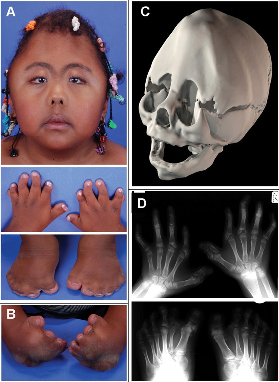 Синдром Апера