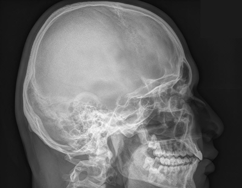 Рентген головного мозга