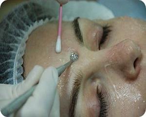 комедоны лечение фото