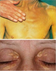 Симптомы холестаза