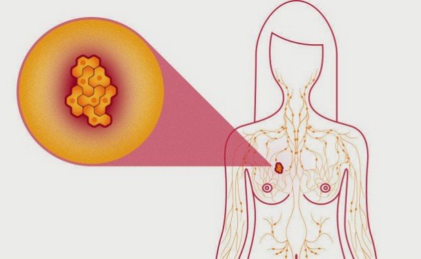 Диагностика рака груди Диагностика рака груди