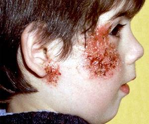 пиодермия фото у детей