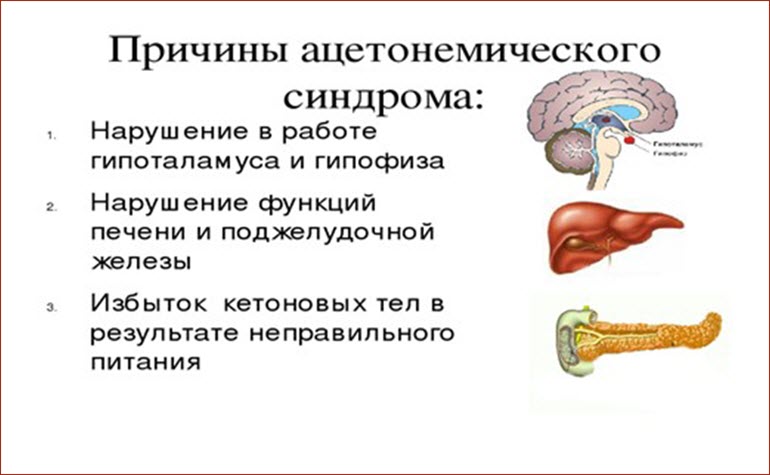 Причины ацетонемического синдрома