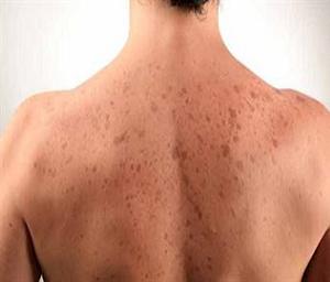 пигментные пятна на теле фото