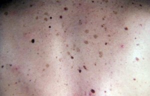 родинки на теле значение фото