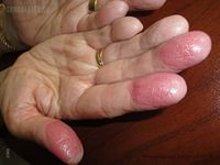 аллергический дерматит