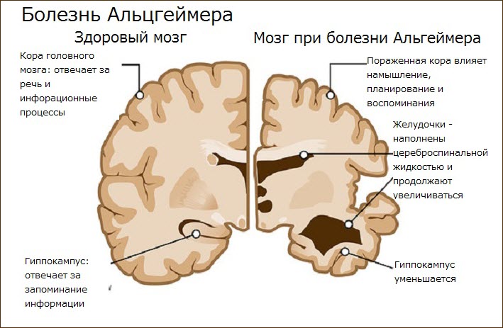 Мозг при болезни Альцгеймера