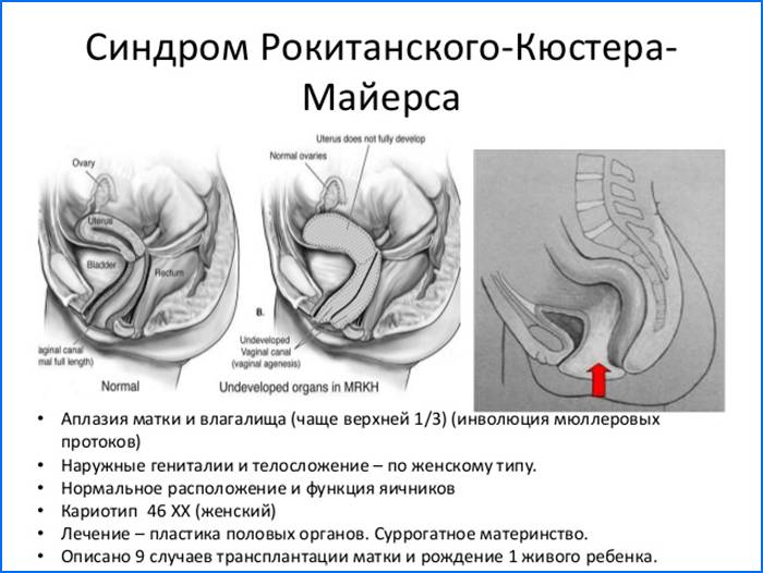 синдром Рокитанского-Кюстнера