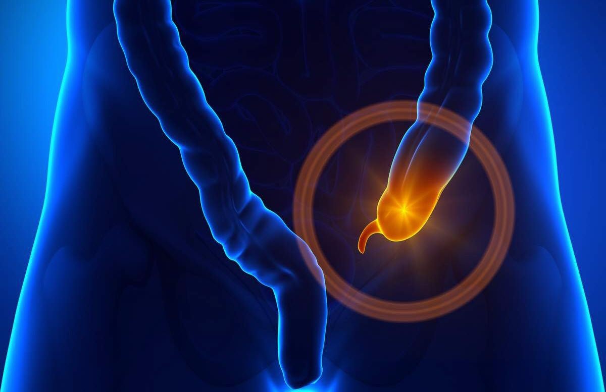 Аппендицит