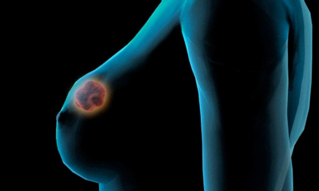 Рак груди 3 стадии