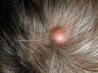 атерома на голове