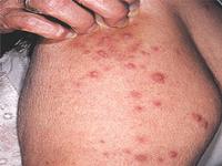 как лечить почесуху