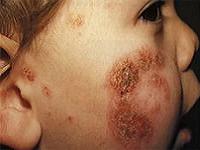 атопический дерматит