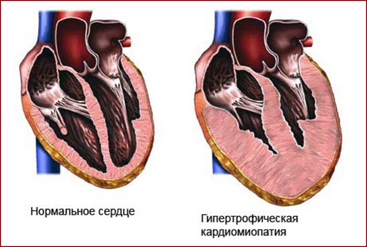Гипертрофическая кардиомиопатия