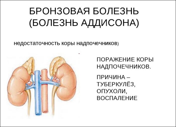 Бронзовая болезнь