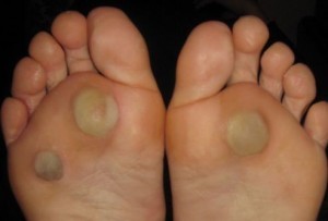 подошвенная бородавка фото лечение народными средствами