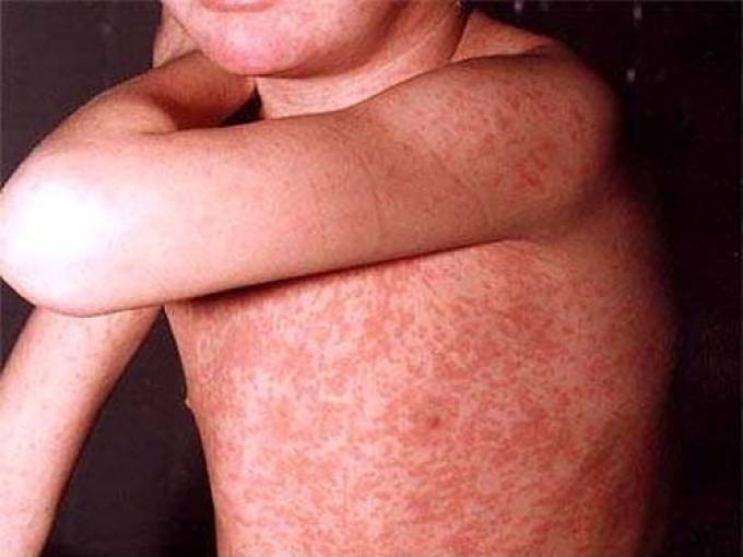 как выглядит потница фото