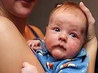 чем лечить диатез на щеках у ребенка