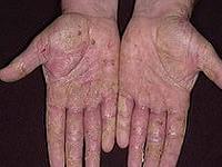 чем лечить дисгидроз кистей рук