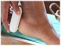 чем лечить мозоль на пятке