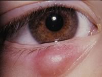 чем лечить ячмень на глазу у ребенка