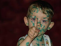 чем отмыть зеленку после ветрянки