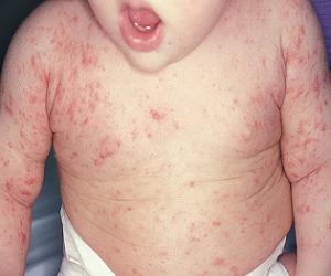 чесотка у детей фото