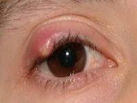 чирей на глазу лечение