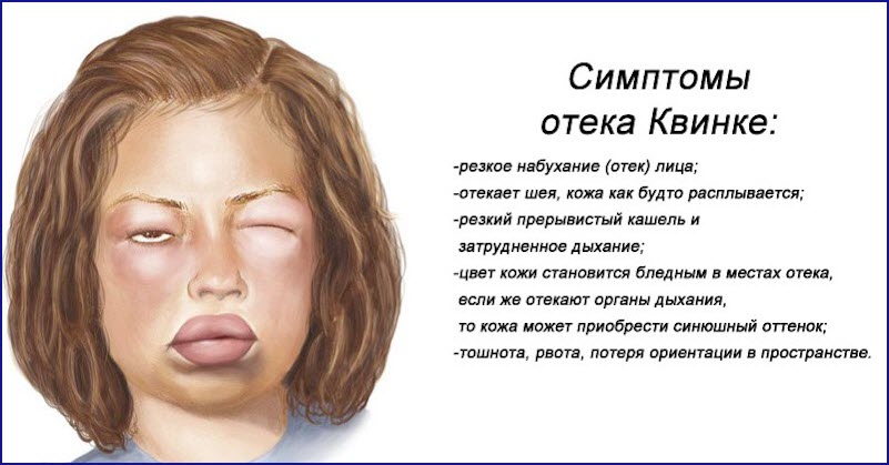 Отек Квинке