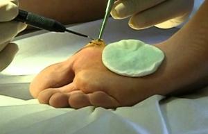 подошвенная бородавка фото лечение