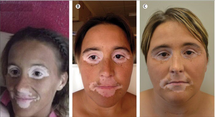 Видимые симптомы бронзовой болезни