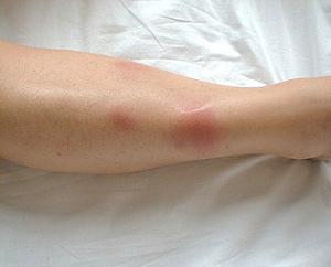 узловатая эритема на ногах лечение фото