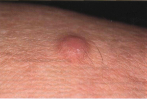 дерматофиброма лечение фото