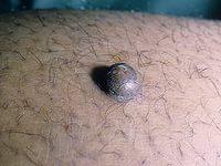 дерматофиброма