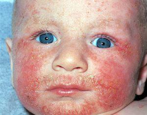 нейродермит на лице фото