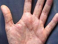 дисгидроз кистей рук